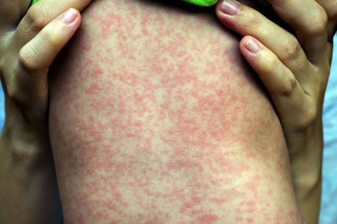 Surco: Minsa reporta caso de sarampión en una bebé de diez meses 