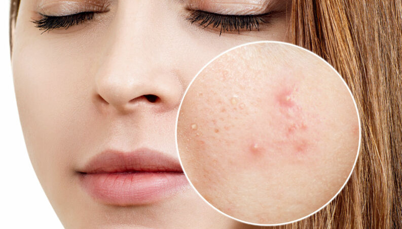 acne-causes