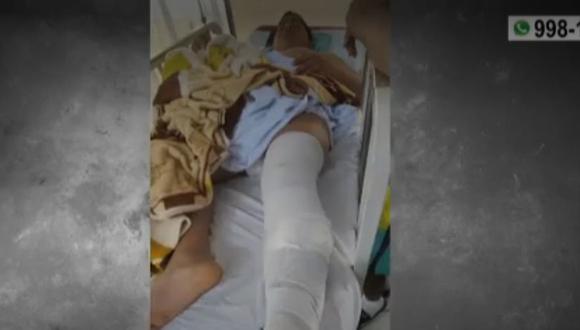 Joven quedó con las piernas fracturadas tras ser atropellado por auto que se dio a la fuga