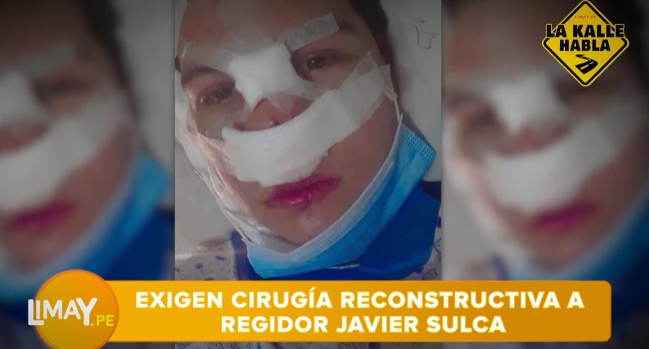 ¡Terrible! Joven se desfiguró el rostro en casa de regidor de Los Olivos