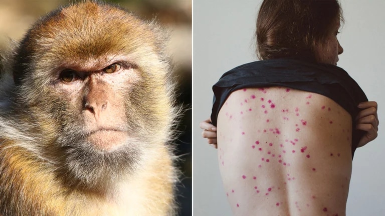 Minsa declarará alerta en Perú por viruela del mono