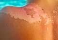 Aquí te decimos cómo prevenir el cáncer a la piel este verano
